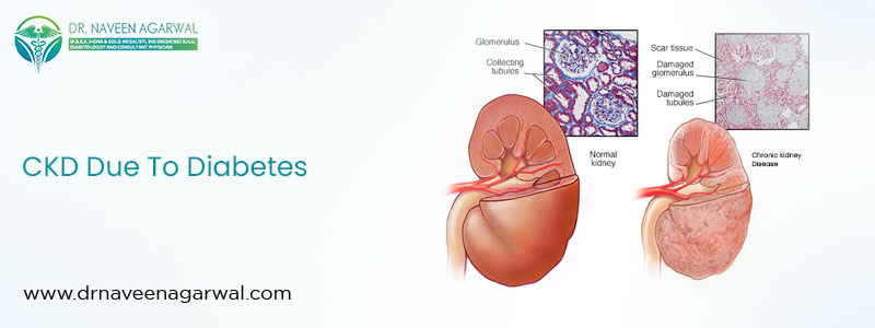 CKD Due To Diabetes